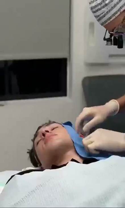 clavicular clip cut by ClipMe