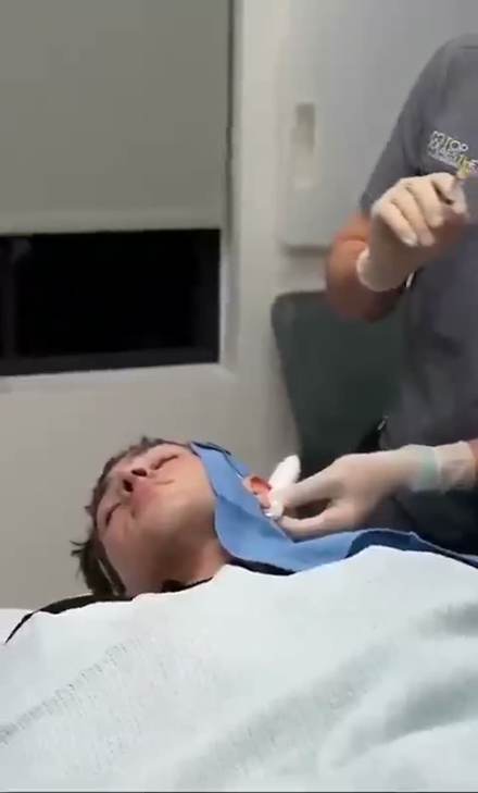 clavicular clip cut by ClipMe