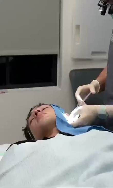 clavicular clip cut by ClipMe