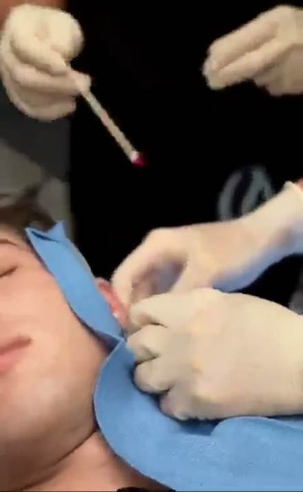 clavicular clip cut by ClipMe